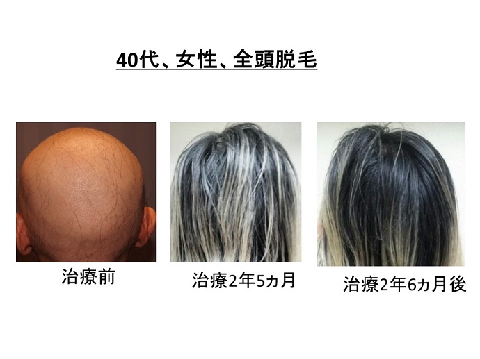 円形脱毛症　病院